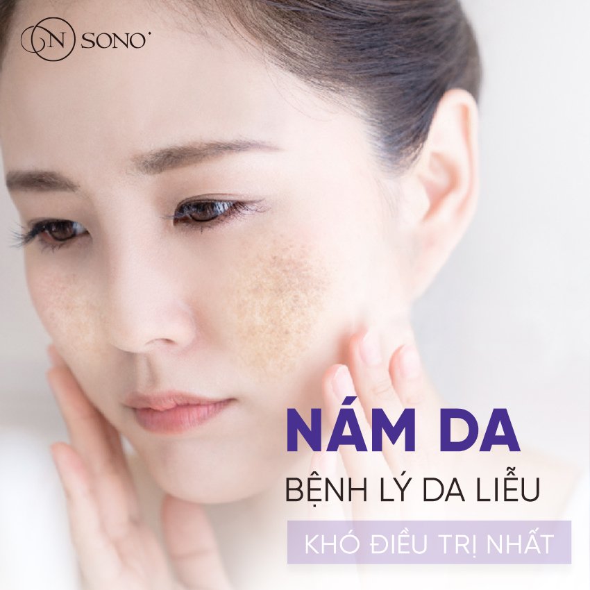 Nám da - Bệnh lý da liễu khó điều trị nhất